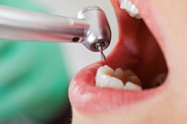 Best Emergency Root Canal Treatment in Mount Vernon, IL
